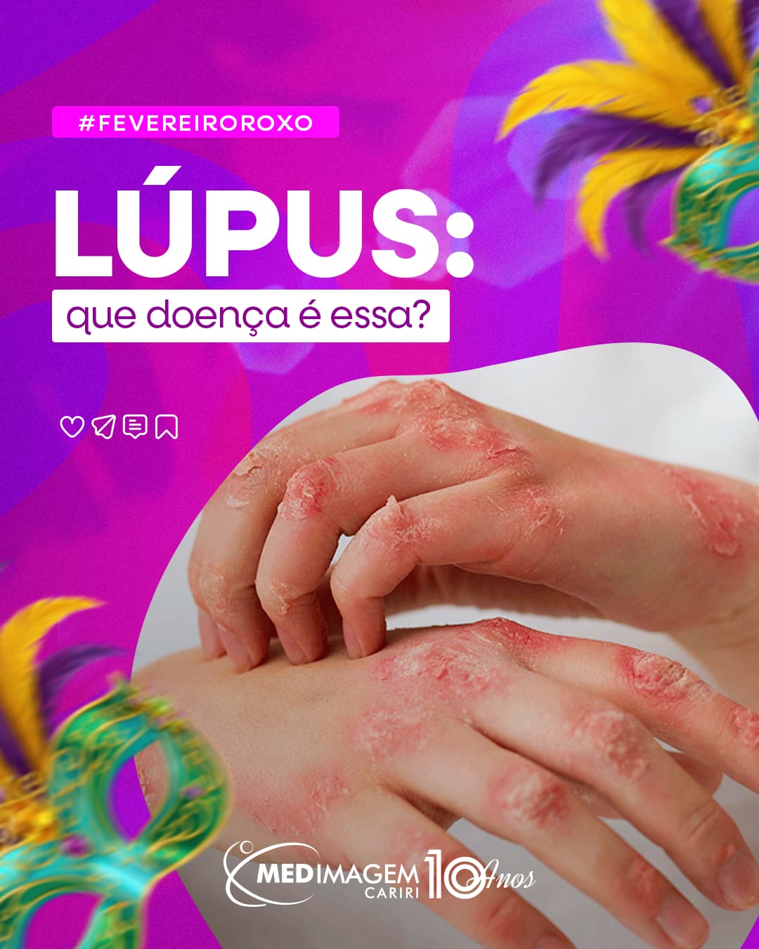 Fevereiro Roxo - Conscientização sobre Lúpus