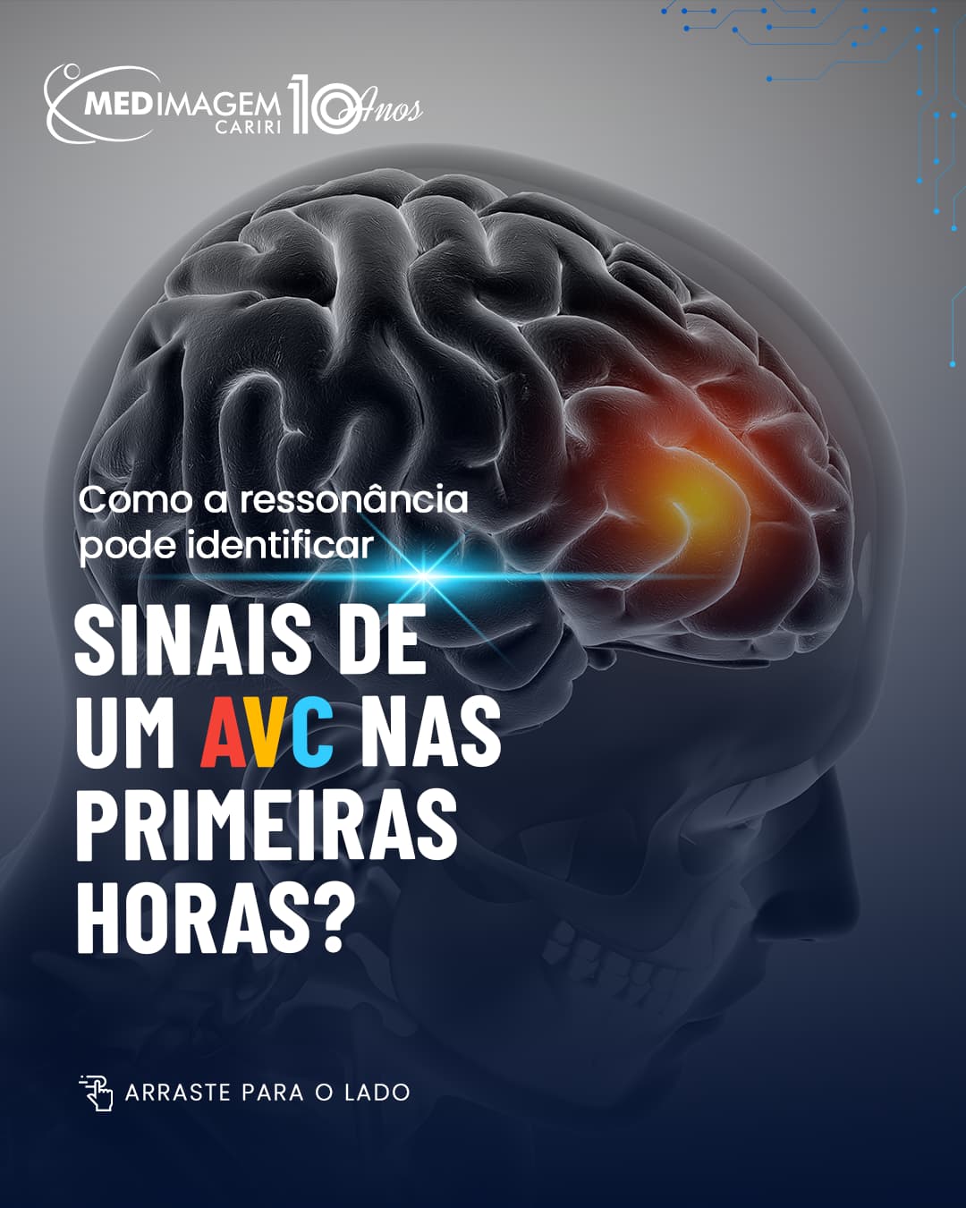 Ressonância magnética na investigação do AVC isquêmico